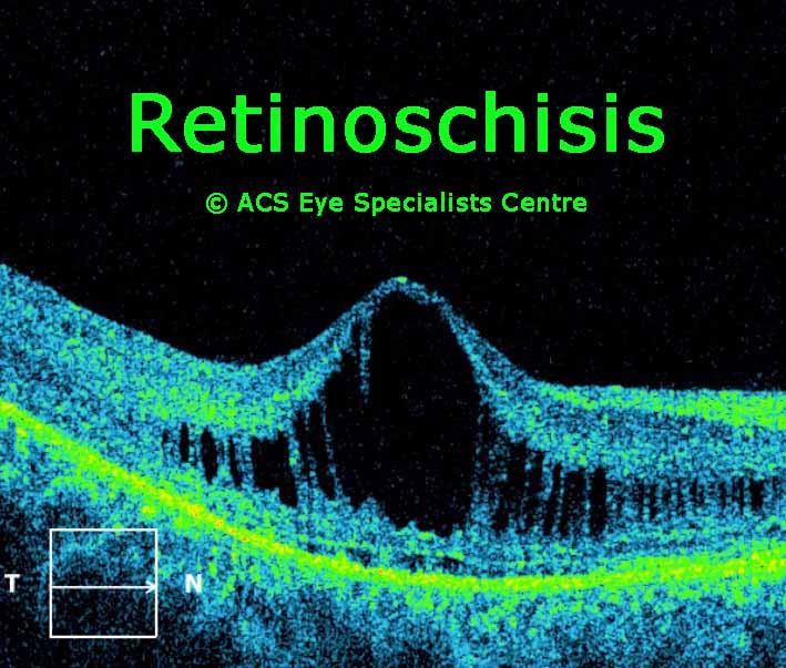 Retinochisis