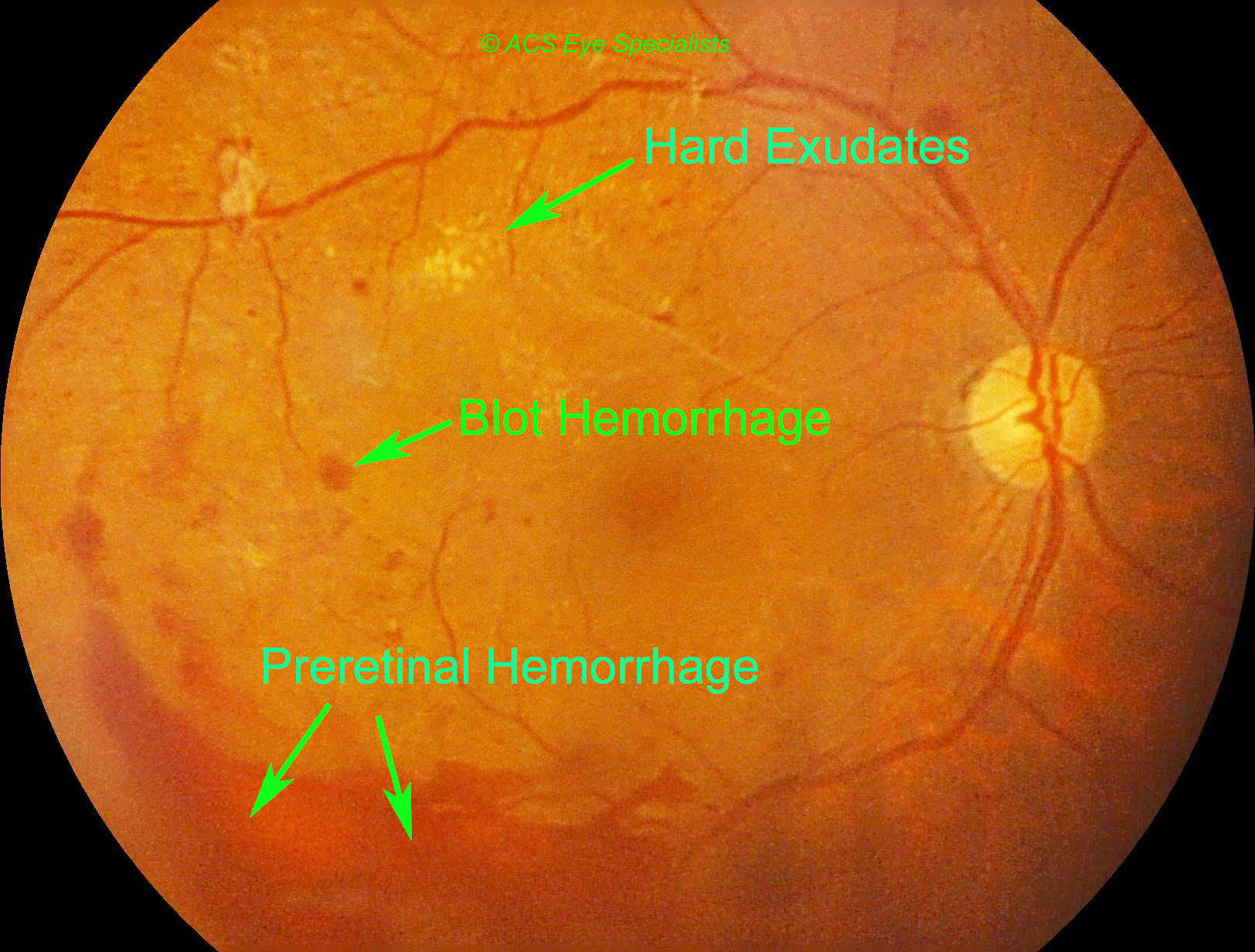 Diabetic Retinopathy preretinal hemorrhage