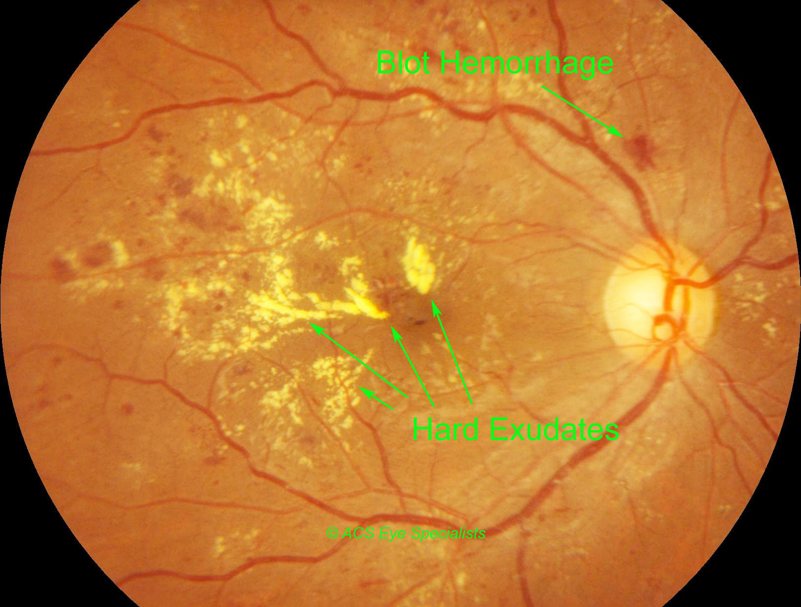 Diabetic Retinopathy blot hemorrhages